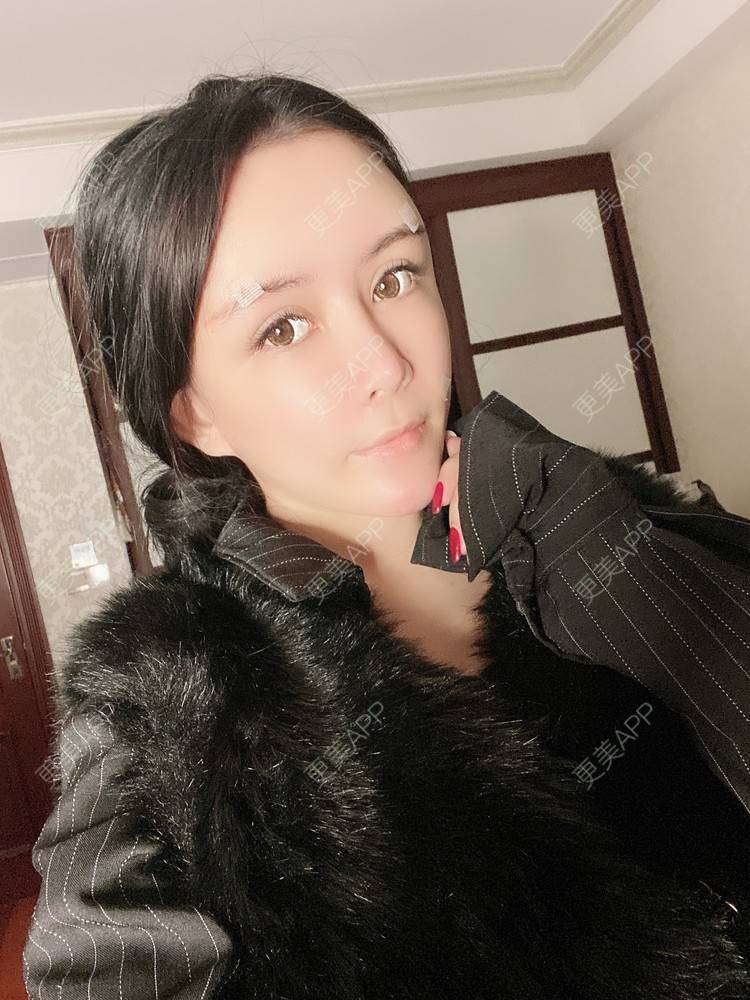 更美 - 更美用户XbSPRKDbDj的自体脂肪填充泪沟经验 | 自体脂肪丰额头 | 自体脂肪丰苹果肌 | 自体脂肪丰太阳穴 | 自体脂肪垫眉弓 | 自体脂肪填充泪沟 | 武汉