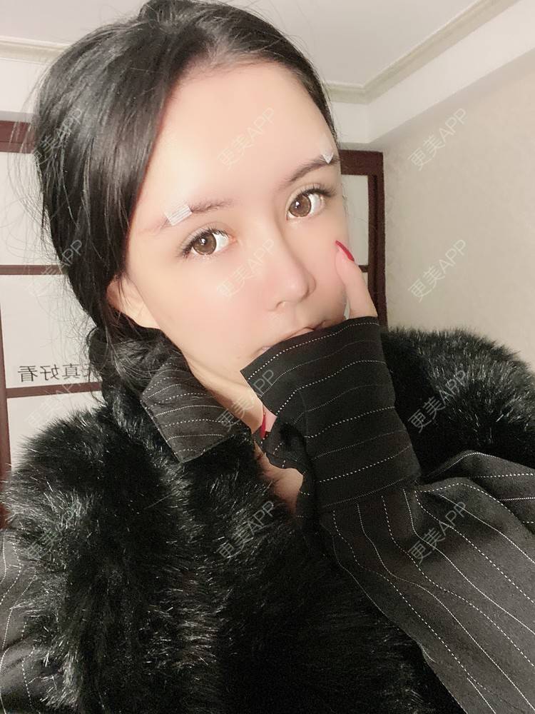 更美 - 更美用户XbSPRKDbDj的自体脂肪填充泪沟经验 | 自体脂肪丰额头 | 自体脂肪丰苹果肌 | 自体脂肪丰太阳穴 | 自体脂肪垫眉弓 | 自体脂肪填充泪沟 | 武汉