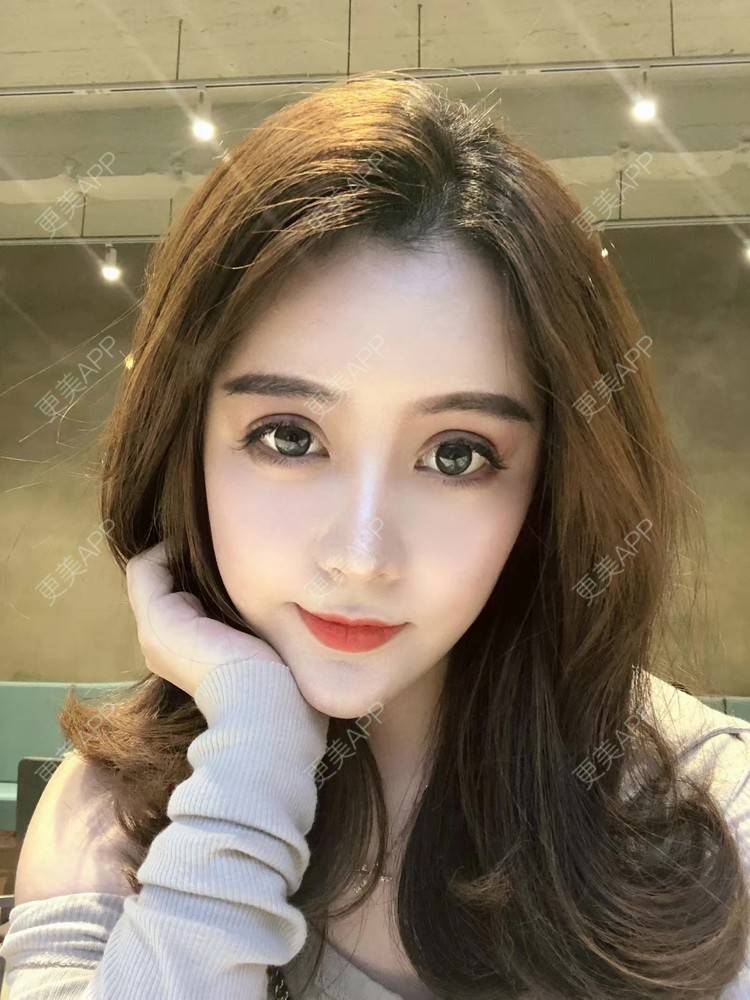 更美 - 更美用户XbSPRKDbDj的自体脂肪填充泪沟经验 | 自体脂肪丰额头 | 自体脂肪丰苹果肌 | 自体脂肪丰太阳穴 | 自体脂肪垫眉弓 | 自体脂肪填充泪沟 | 武汉