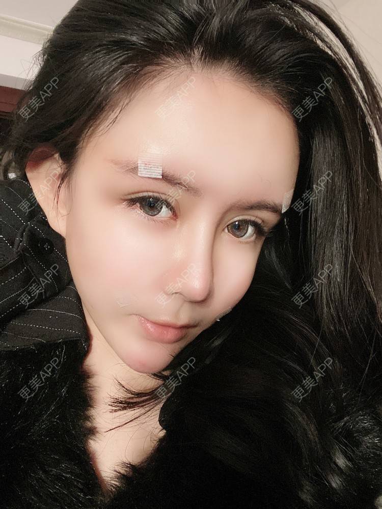 更美 - 更美用户XbSPRKDbDj的自体脂肪填充泪沟经验 | 自体脂肪丰额头 | 自体脂肪丰苹果肌 | 自体脂肪丰太阳穴 | 自体脂肪垫眉弓 | 自体脂肪填充泪沟 | 武汉