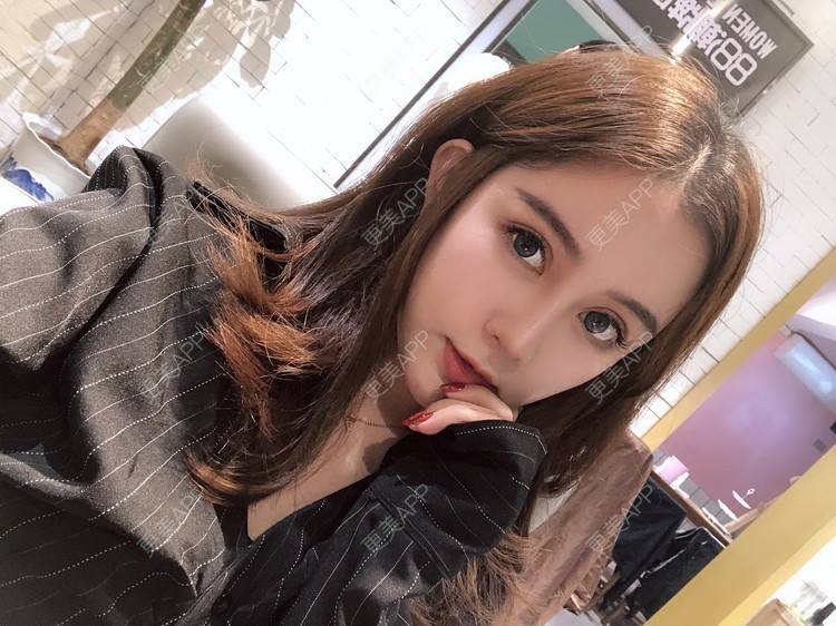 更美 - 更美用户XbSPRKDbDj的自体脂肪填充泪沟经验 | 自体脂肪丰额头 | 自体脂肪丰苹果肌 | 自体脂肪丰太阳穴 | 自体脂肪垫眉弓 | 自体脂肪填充泪沟 | 武汉