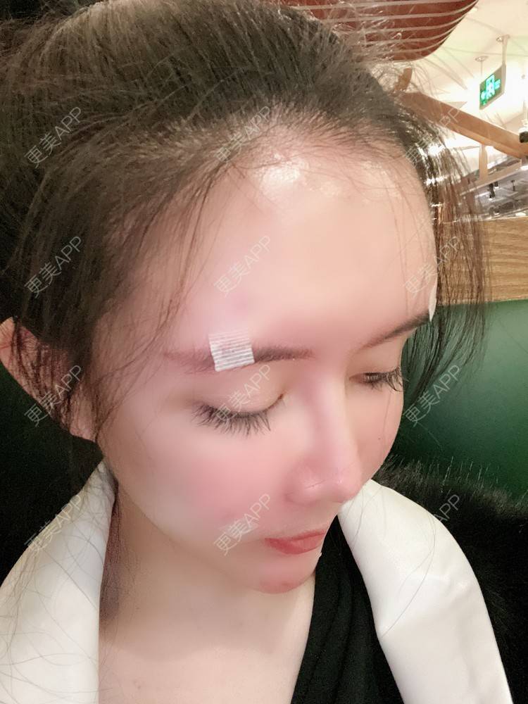 更美 - 更美用户XbSPRKDbDj的自体脂肪填充泪沟经验 | 自体脂肪丰额头 | 自体脂肪丰苹果肌 | 自体脂肪丰太阳穴 | 自体脂肪垫眉弓 | 自体脂肪填充泪沟 | 武汉