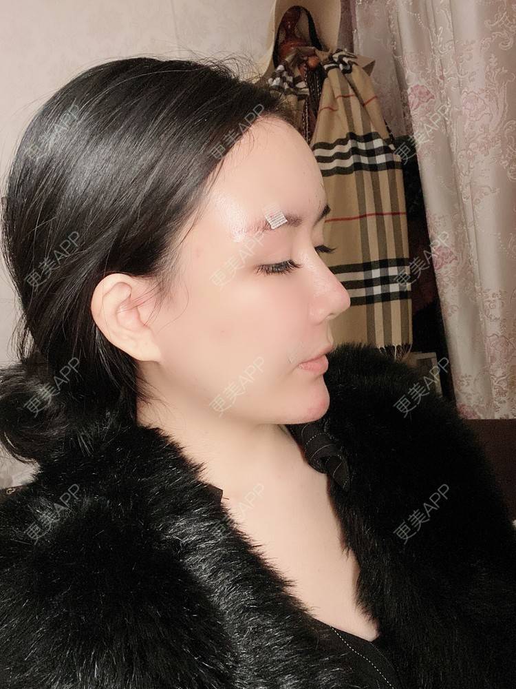 更美 - 更美用户XbSPRKDbDj的自体脂肪填充泪沟经验 | 自体脂肪丰额头 | 自体脂肪丰苹果肌 | 自体脂肪丰太阳穴 | 自体脂肪垫眉弓 | 自体脂肪填充泪沟 | 武汉