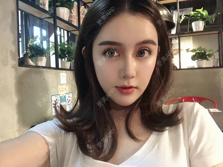 更美 - 更美用户XbSPRKDbDj的自体脂肪填充泪沟经验 | 自体脂肪丰额头 | 自体脂肪丰苹果肌 | 自体脂肪丰太阳穴 | 自体脂肪垫眉弓 | 自体脂肪填充泪沟 | 武汉