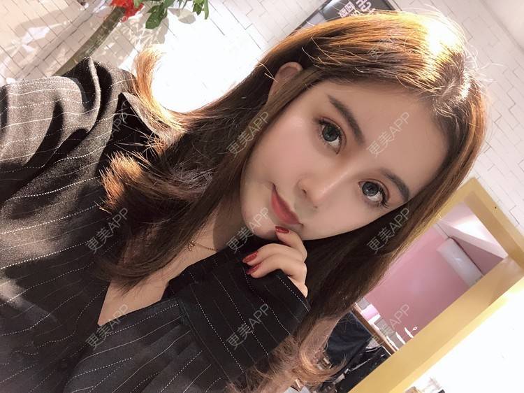 更美 - 更美用户XbSPRKDbDj的自体脂肪填充泪沟经验 | 自体脂肪丰额头 | 自体脂肪丰苹果肌 | 自体脂肪丰太阳穴 | 自体脂肪垫眉弓 | 自体脂肪填充泪沟 | 武汉