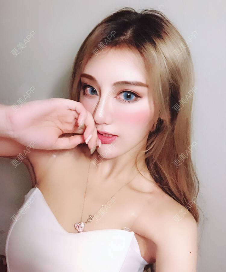 momol的切开双眼皮日记