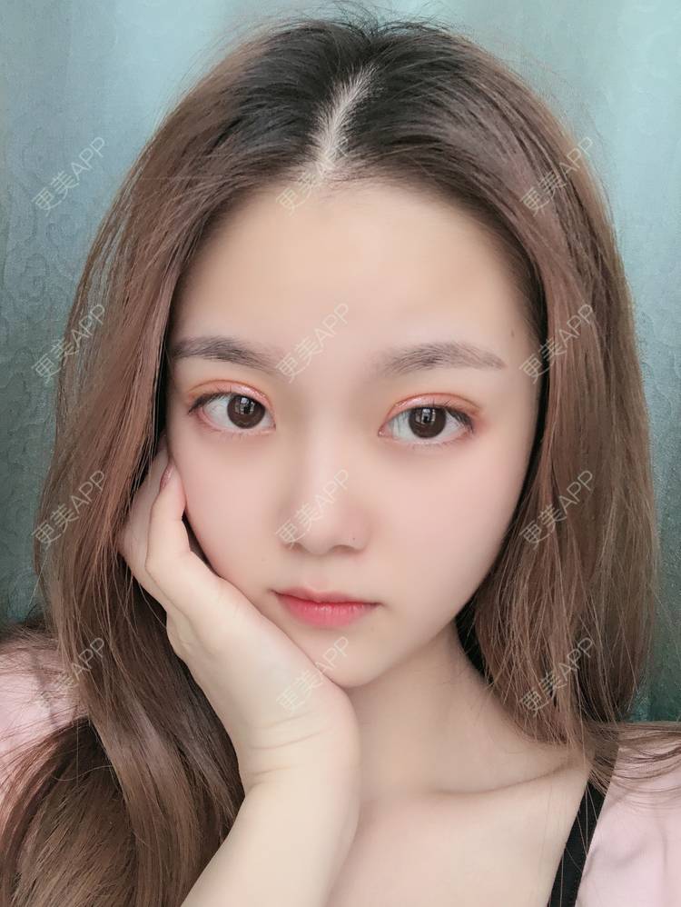 更美用户x6cvq1M3DF的切开双眼皮日记