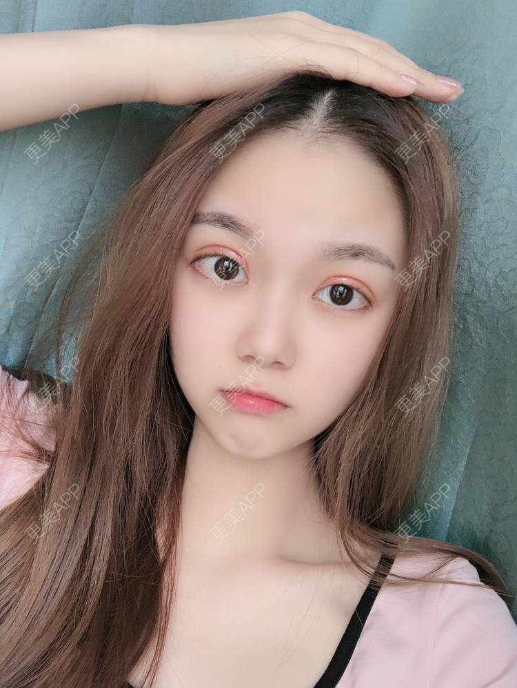 更美用户x6cvq1M3DF的切开双眼皮日记