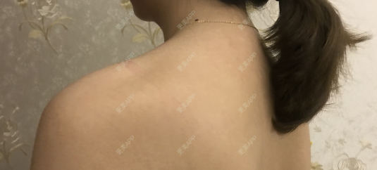 更美 - 更美用户dDjjJrAmod的注射塑形肩部经验 | 注射塑形肩部 | 成都