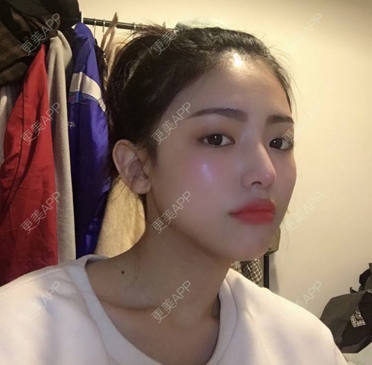 兔牙喵喵喵的光子嫩肤日记