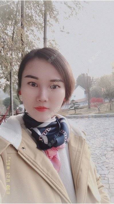 更美 - 安迪🌷的玻尿酸面颊经验 | 上海 | 玻尿酸面颊