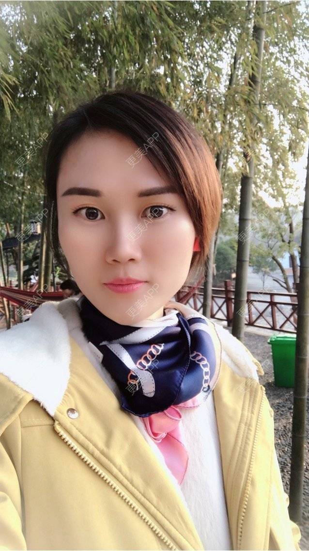 更美 - 安迪🌷的玻尿酸面颊经验 | 上海 | 玻尿酸面颊