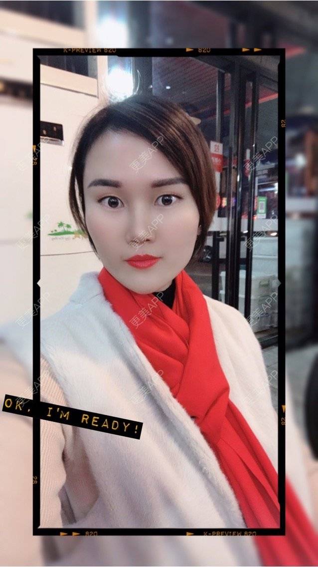 更美 - 安迪🌷的玻尿酸面颊经验 | 上海 | 玻尿酸面颊