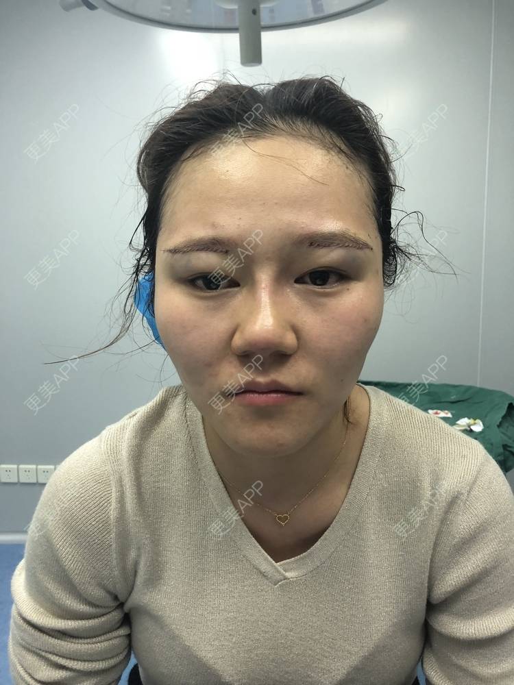 更美 - 反正我就是爱你的切眉经验 | 切眉 | 武汉