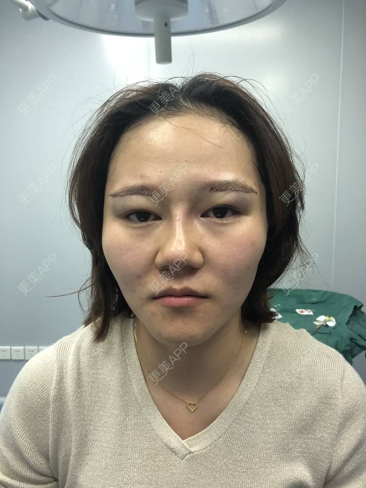 更美 - 反正我就是爱你的切眉经验 | 切眉 | 武汉
