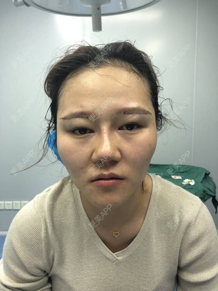 更美 - 反正我就是爱你的切眉经验 | 切眉 | 武汉