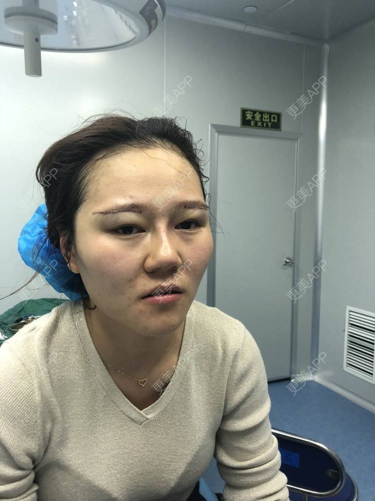 更美 - 反正我就是爱你的切眉经验 | 切眉 | 武汉