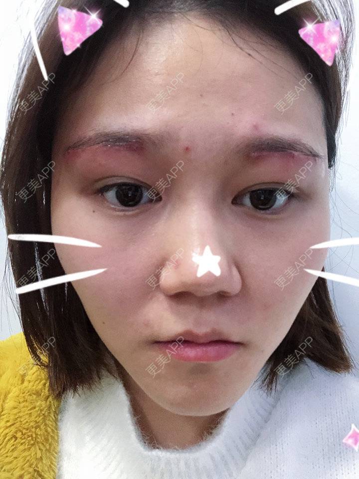 更美 - 反正我就是爱你的切眉经验 | 切眉 | 武汉