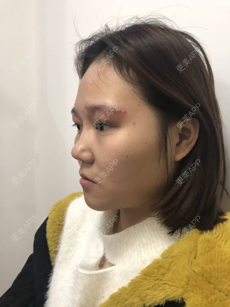 更美 - 反正我就是爱你的切眉经验 | 切眉 | 武汉