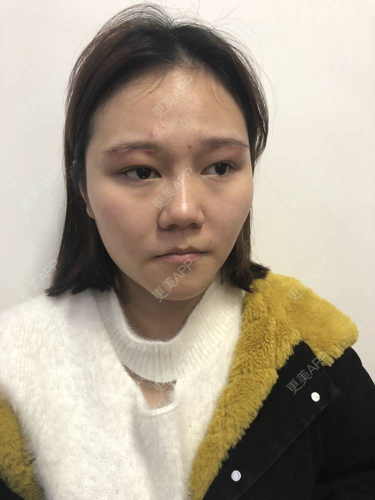 更美 - 反正我就是爱你的切眉经验 | 切眉 | 武汉