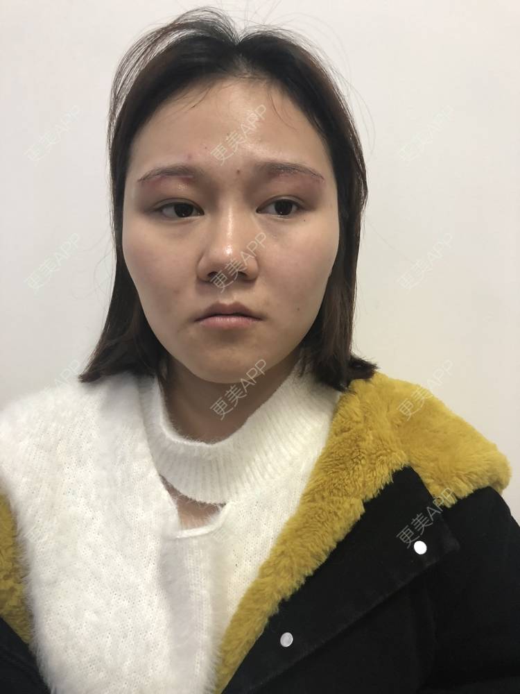 更美 - 反正我就是爱你的切眉经验 | 切眉 | 武汉
