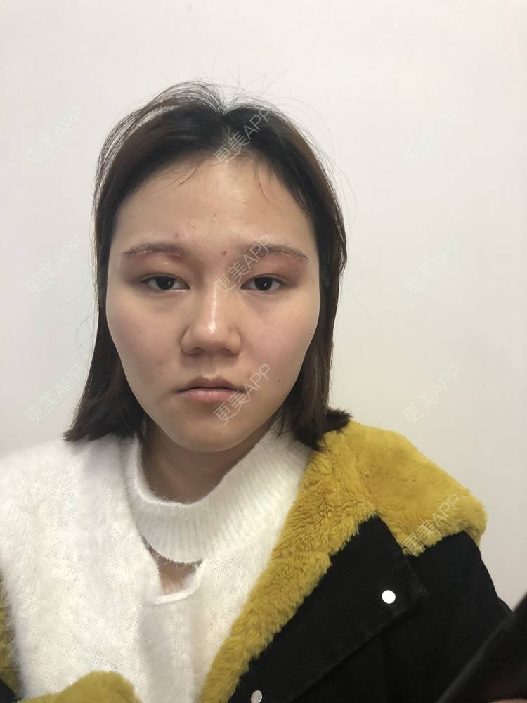 更美 - 反正我就是爱你的切眉经验 | 切眉 | 武汉