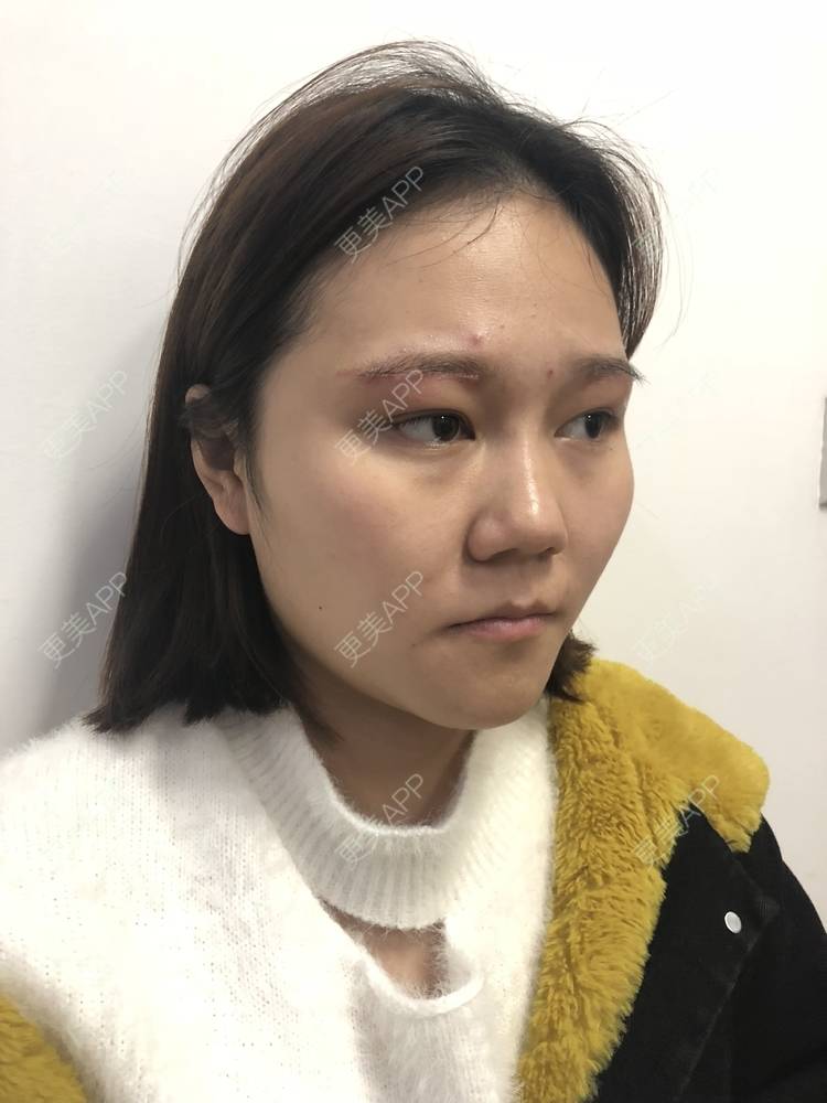 更美 - 反正我就是爱你的切眉经验 | 切眉 | 武汉