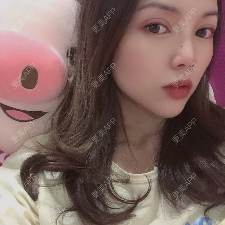 更美 - 更美用户T3PhxaY9Vo的玻尿酸下巴经验 | 广州 | 视频日记 | 玻尿酸下巴