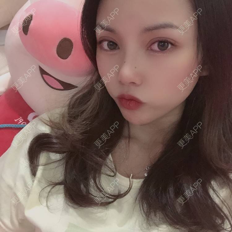 更美 - 更美用户T3PhxaY9Vo的玻尿酸下巴经验 | 广州 | 视频日记 | 玻尿酸下巴