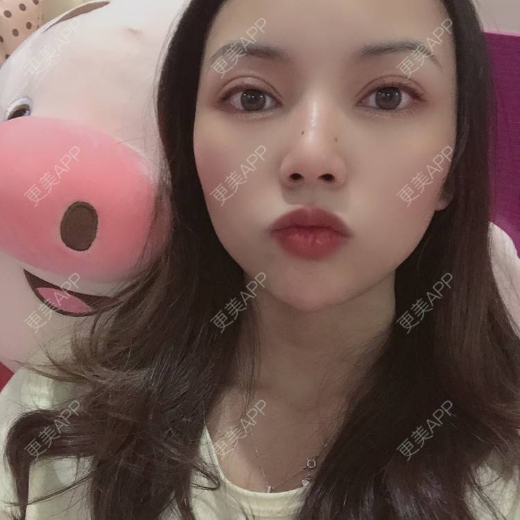 更美 - 更美用户T3PhxaY9Vo的玻尿酸下巴经验 | 广州 | 视频日记 | 玻尿酸下巴
