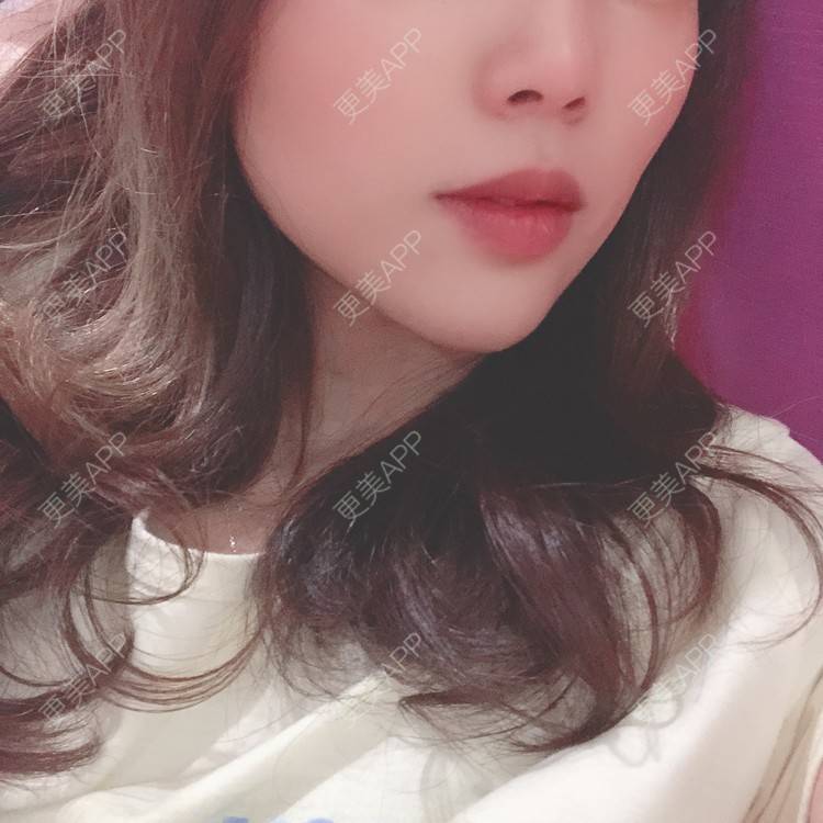 更美 - 更美用户T3PhxaY9Vo的玻尿酸下巴经验 | 广州 | 视频日记 | 玻尿酸下巴