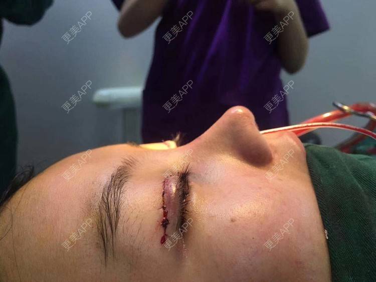 更美 - 变美找我~的肋软骨隆鼻经验 | 肋软骨隆鼻 | 鼻翼缩小 | 宁波 | 鼻孔矫正 | 眼部多项 | 自体肋软骨垫鼻基底