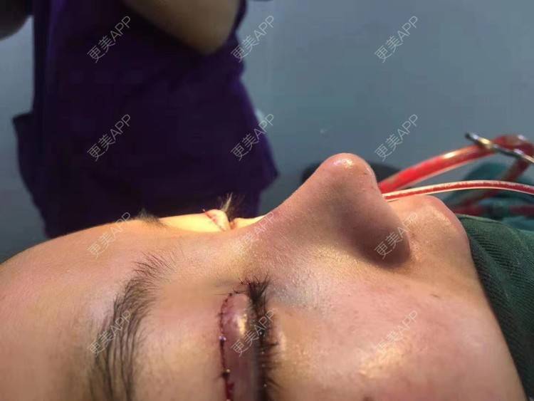 更美 - 变美找我~的肋软骨隆鼻经验 | 肋软骨隆鼻 | 鼻翼缩小 | 宁波 | 鼻孔矫正 | 眼部多项 | 自体肋软骨垫鼻基底