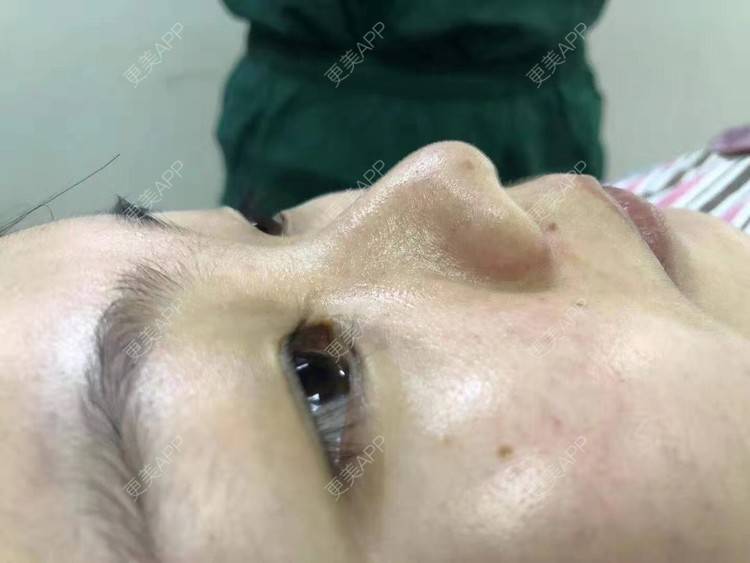 更美 - 变美找我~的肋软骨隆鼻经验 | 肋软骨隆鼻 | 鼻翼缩小 | 宁波 | 鼻孔矫正 | 眼部多项 | 自体肋软骨垫鼻基底