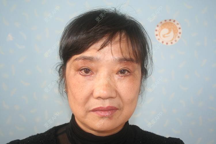更美 - I 🌺u的切眉经验 | 切眉 | 武汉