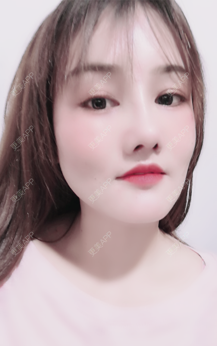 鼻综合多少钱_圈圈圆圆小妞妞鼻综合多少钱_术后164天__更美整形