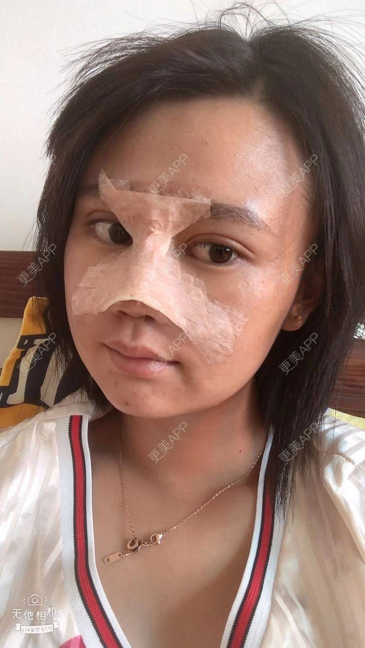 更美 - 昆明梦想医疗美容医院的隆鼻经验 | 肋软骨隆鼻 | 隆鼻
