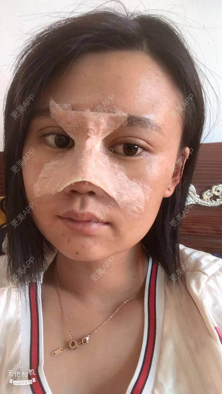 更美 - 昆明梦想医疗美容医院的隆鼻经验 | 肋软骨隆鼻 | 隆鼻