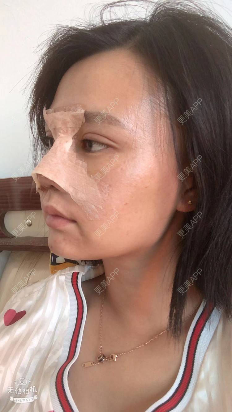 更美 - 昆明梦想医疗美容医院的隆鼻经验 | 肋软骨隆鼻 | 隆鼻