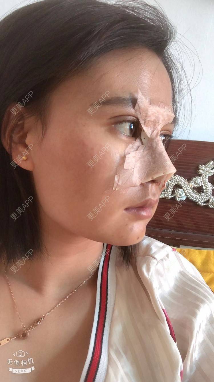 更美 - 昆明梦想医疗美容医院的隆鼻经验 | 肋软骨隆鼻 | 隆鼻