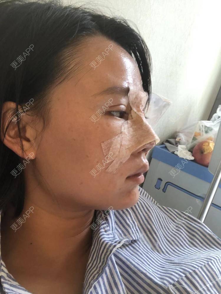 更美 - 昆明梦想医疗美容医院的隆鼻经验 | 肋软骨隆鼻 | 隆鼻