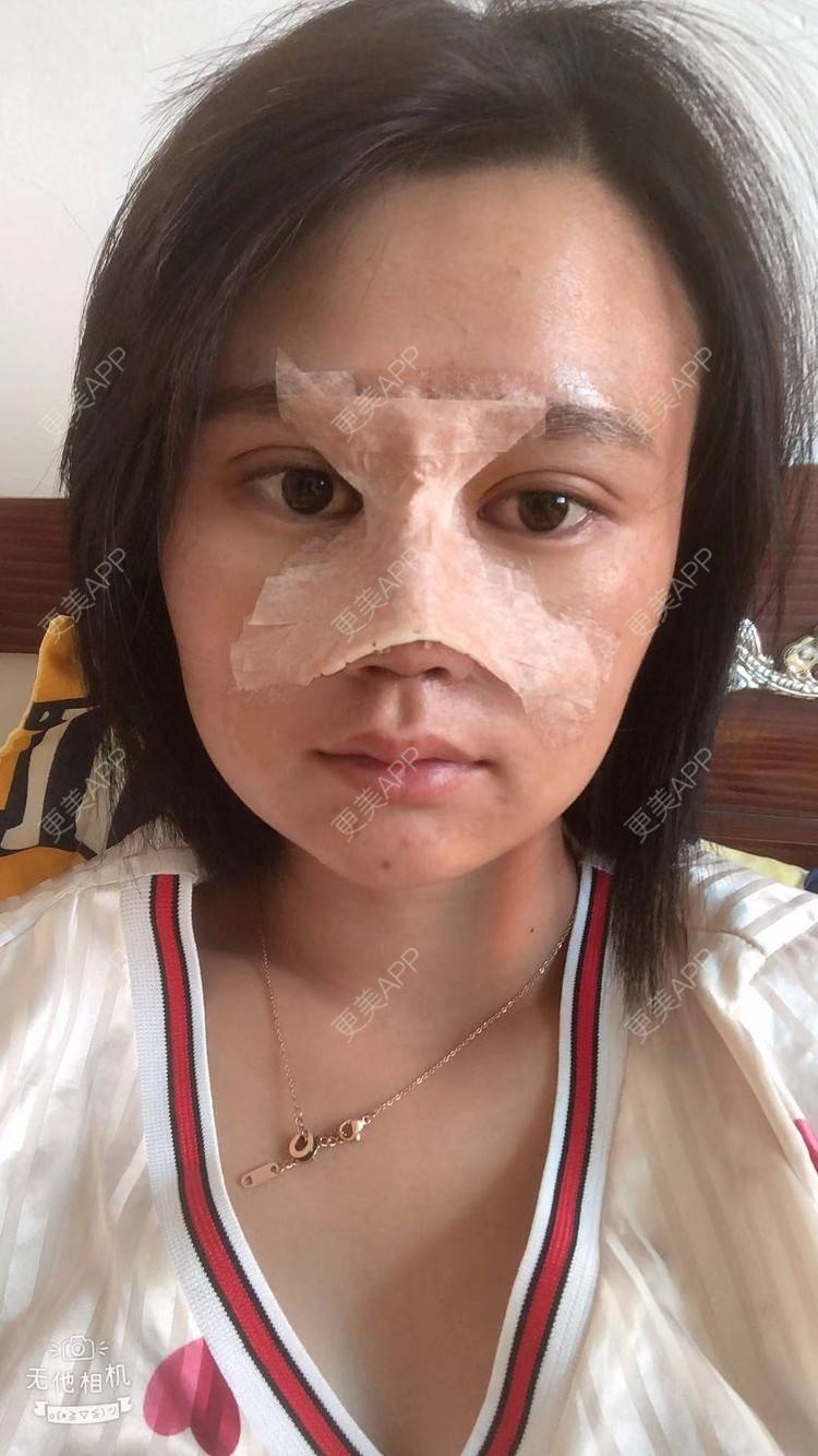 更美 - 昆明梦想医疗美容医院的隆鼻经验 | 肋软骨隆鼻 | 隆鼻