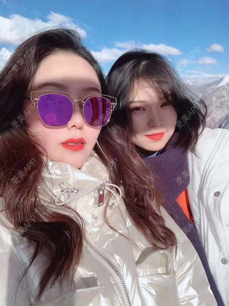 更美 - 更美用户dapPewZ45A的自体脂肪丰额头经验 | 自体脂肪丰额头 | 重庆