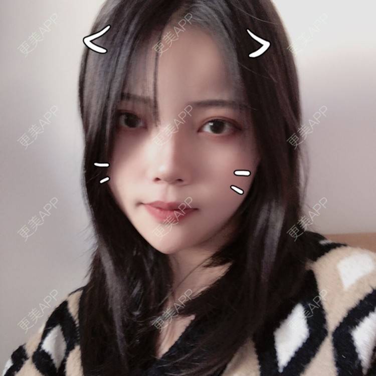 更美 - . Kylla rrrrr🔻的玻尿酸面颊经验 | 上海 | 玻尿酸面颊