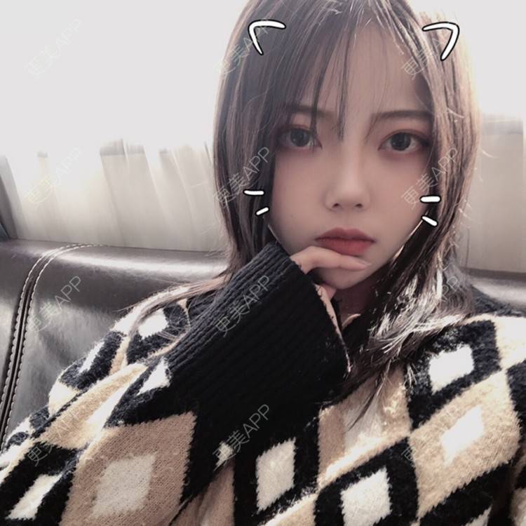 更美 - . Kylla rrrrr🔻的玻尿酸面颊经验 | 上海 | 玻尿酸面颊