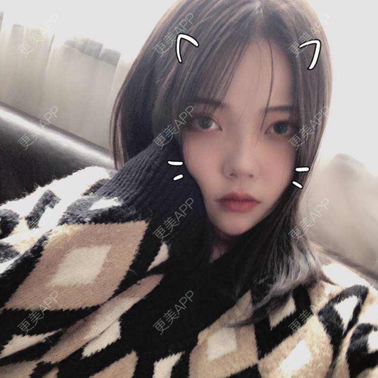 更美 - . Kylla rrrrr🔻的玻尿酸面颊经验 | 上海 | 玻尿酸面颊