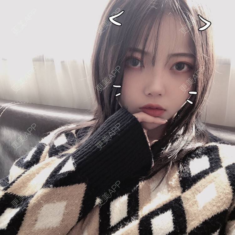 更美 - . Kylla rrrrr🔻的玻尿酸面颊经验 | 上海 | 玻尿酸面颊