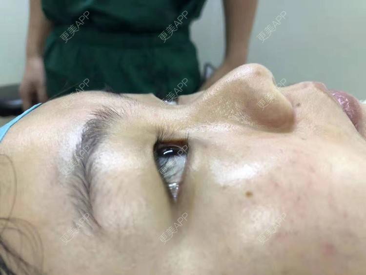 更美 - 变美找我~的肋软骨隆鼻经验 | 肋软骨隆鼻 | 鼻翼缩小 | 宁波 | 鼻孔矫正 | 眼部多项 | 自体肋软骨垫鼻基底