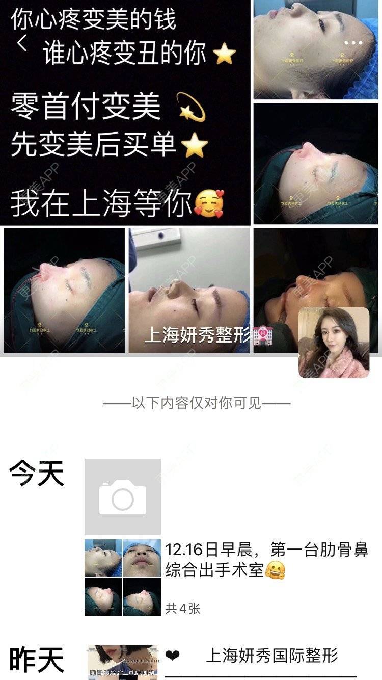 更美 - 变美找我~的肋软骨隆鼻经验 | 肋软骨隆鼻 | 鼻翼缩小 | 宁波 | 鼻孔矫正 | 眼部多项 | 自体肋软骨垫鼻基底