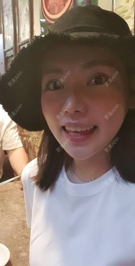 更美 - 律儿的鼻部多项经验 | 宽下巴矫正 | 鼻部多项